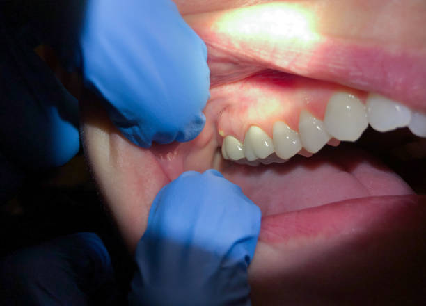 Best Emergency Wisdom Teeth Removal in Leadington, MO
